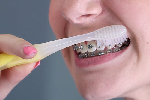 Oral Hygiene For The Orthodontic Patient