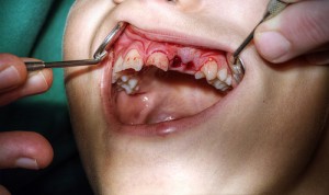 child-with-knocked-out-tooth-at-the-dentis-300x178